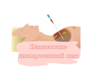  Использование декомпрессионной иглы